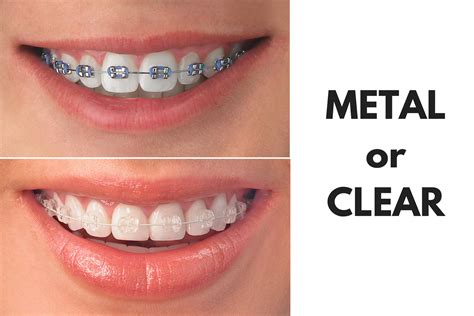 clear brackets vs metal brackets braces|ceramic brackets vs metal.